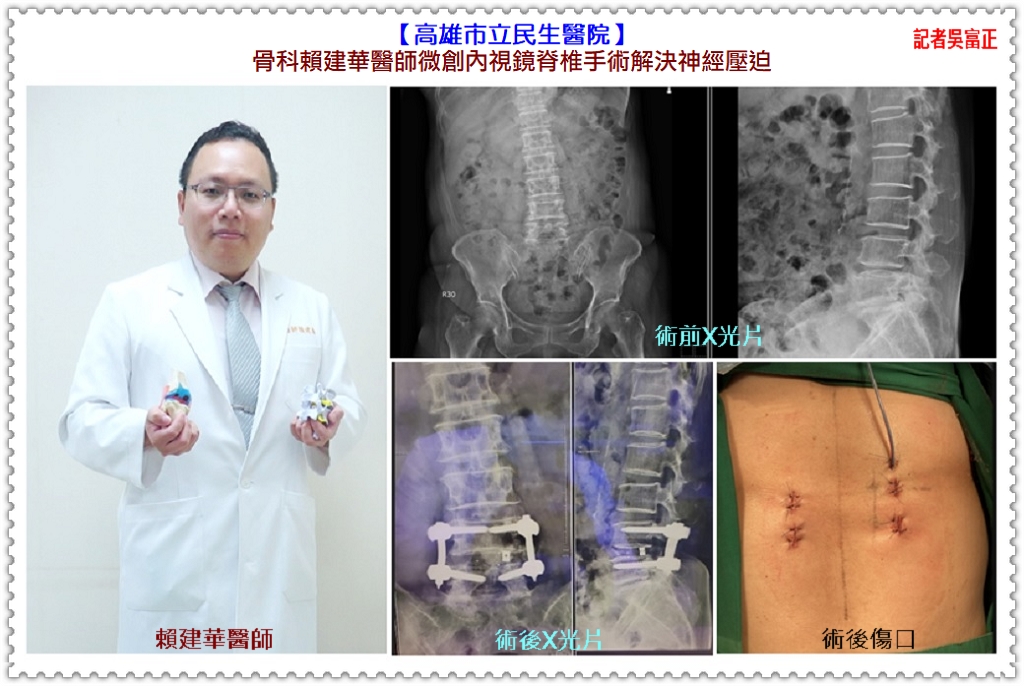 民生醫院骨科賴建華醫師微創內視鏡脊椎手術解決神經壓迫＠華夏新聞報