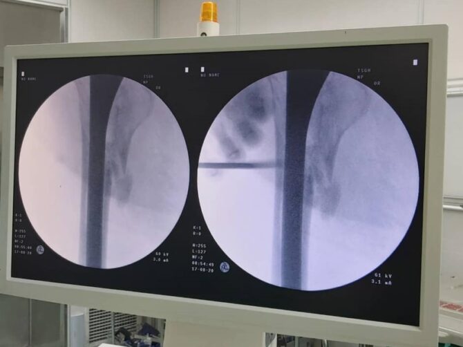防止骨關節退化 醫師呼籲:用正確運動來預防